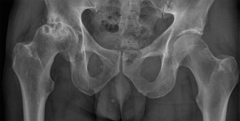3. stádiumú csípőízület arthrosis röntgenfelvételen