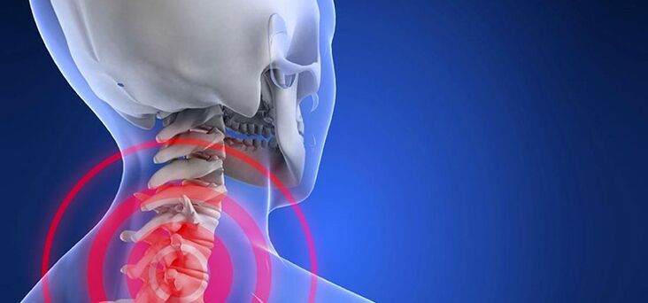 A méhnyakos régió osteochondrosis