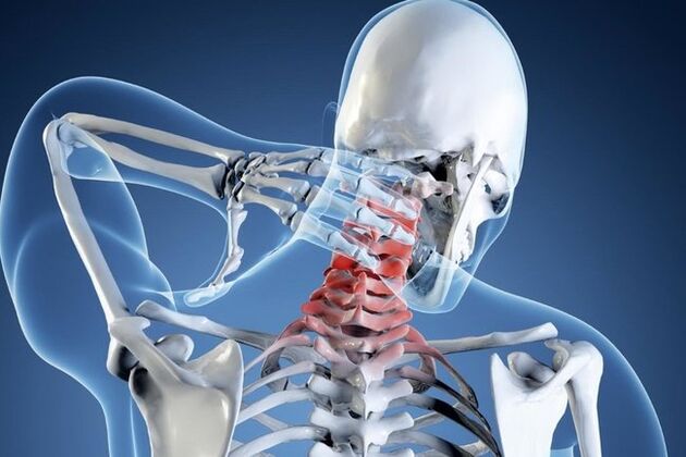 A méhnyakos régió osteochondrosis