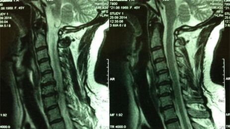 A méhnyak osztály MRI