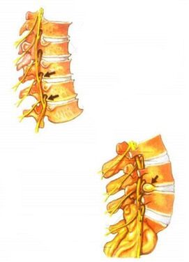illusztráció a gerinc osteochondrosisáról