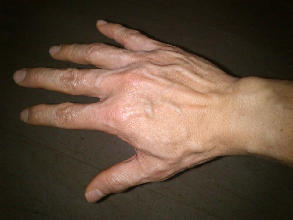 csontok deformációja és fájdalom az ujjak ízületeiben