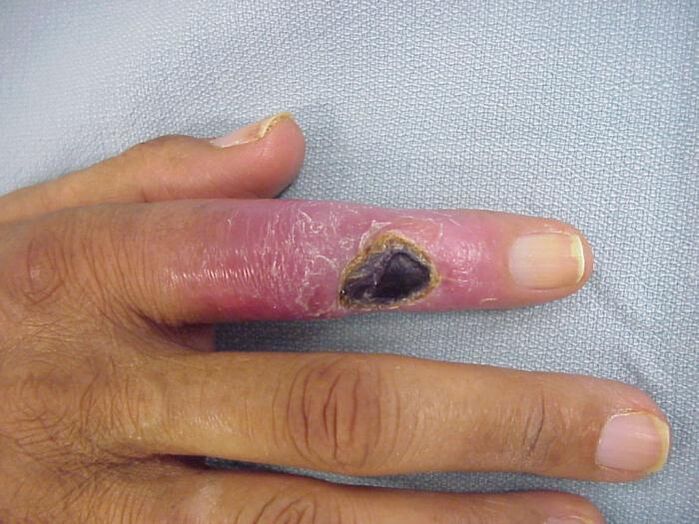 osteomyelitis, mint az ujjak ízületi fájdalmának oka