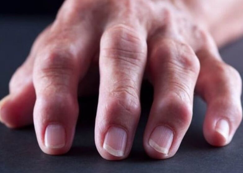 rheumatoid arthritis, mint az ujjak ízületi fájdalmának oka