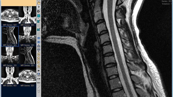 A nyaki gerinc MRI a legjobb módszer a nyaki fájdalom diagnosztizálására