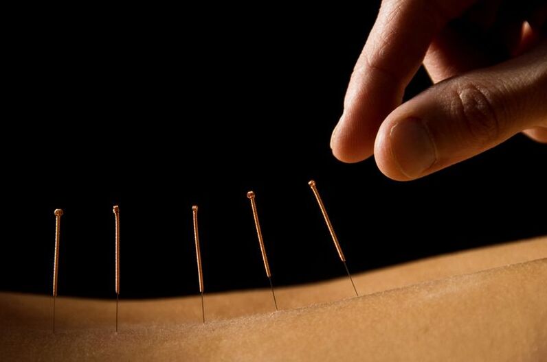 akupunktúra hátfájásra